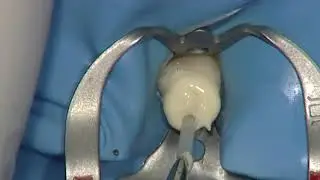Itena Dentocore : Core Build Up and Post Cementation Composite Material