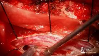 Live Surgery: Resection of Spinal Tumor - Rod J. Oskouian, M.D.