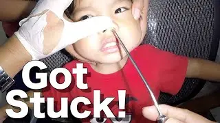 How to Remove Foreign Body Stuck Inside the Nose