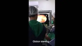 EUS guided hepaticogastrostomy with Giobor stent