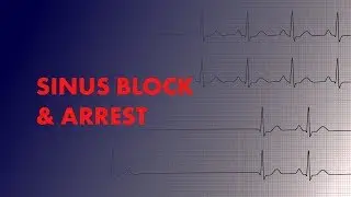 Sinus Block and Sinus Arrest - EKG (ECG) Interpretation