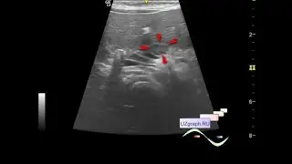 Pediatric abdominal ultrasound - Lesion in the projection of the pancreas body