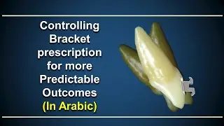Controlling bracket prescription for more predictable outcomes (Arabic)