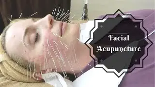 Facial Acupuncture | Korean Beauty Secret