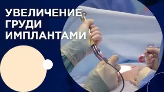 Зыков: Увеличение груди имплантами. Маммопластика.