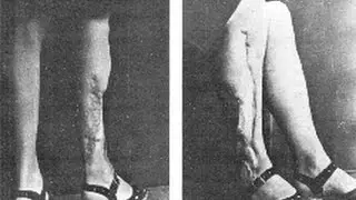 6 Worst Nazi Human Experiments