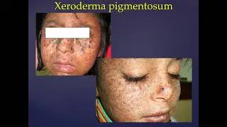 Pre cancerous and cancerous skin diseases.