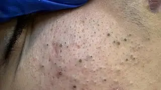 ASMR Blackhead Removal & Deep Cleansing | Skincare Solutions for Clear Skin