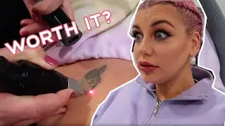 Laser Tattoo Removal Vlog #2 😳