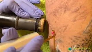 Laser Tattoo Removal at Well Medical Arts in Seattle