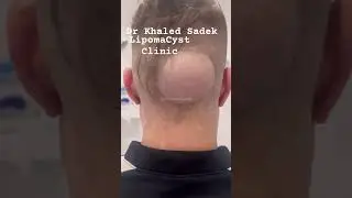 What’s this ? Dr Khaled Sadek #skincare #blackheadremoval LipomaCyst clinic
