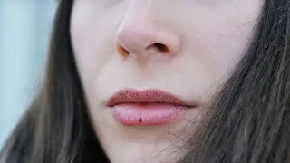 Лаблар ёрилиши хакида лаб ёрилса нима килиш керак