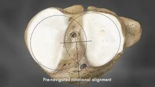 iTotal G2 Knee Implant Fit Animation | Conformis