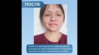 Паралич лица после удаления опухоли. Результат перемещения мышцы.