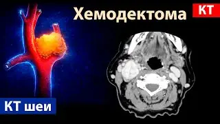 Лучевая диагностика хемодектомы