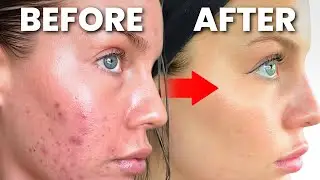 HOW TO GET RID OF ACNE, PIMPLES, HORMONAL, CYSTIC ACNE, BLACKHEADS, WHITEHEADS