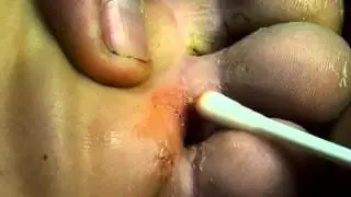 Vídeo nojento e asqueroso - tirando bicho de pé - Macro HD