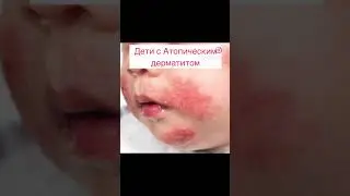 Все про заболевание АТОПИЧЕСКИЙ ДЕРМАТИТ от 