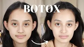 PERTAMA KALI BOTOX | first time getting jaw botox