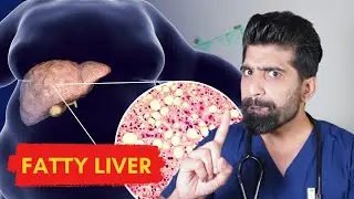 Fatty Liver DECODED | Doctor Explains 🚨