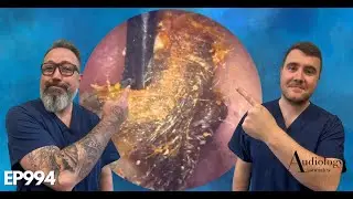 WE USED A MANUAL TOOL TO REMOVE EARWAX - EP994