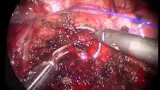 Precision Cautery Excision of Deep-Seated Lung Hamartoma by Video...