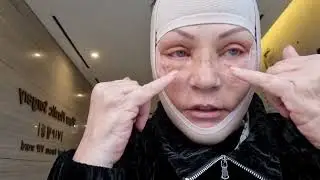 Моя пластическая операция . СЕДЬМОЙ ДЕНЬ  с Докфайндеркорея в клинике View Plastic Surgery Korea