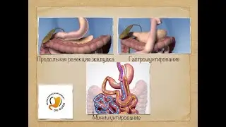 Как правильно выбрать бариатрическую операцию?