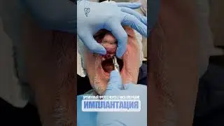 Временный протез через 2 часа операции. Temporary prosthesis after 2 hours of surgery.