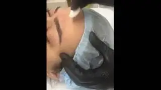 Пилинг Джесснера