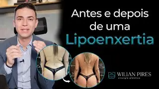 Tudo Que Você Precisa Saber Sobre a Lipoenxertia | Dr. Wilian Pires