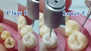 class I preparation for amalgam restoration mandibular first premolar (lower 5)