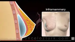 Breast Augmentation with Implants (3D Animation) - Dr. Güncel Öztürk