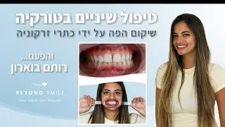 טיפולי שיניים בטורקיה עם ביונד סמייל - החיוך המושלם של רותם