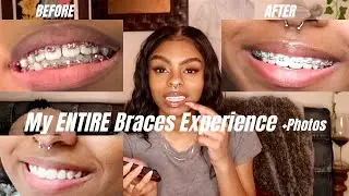 My FULL Braces Journey + One Year Post Retainer Loss UPDATE