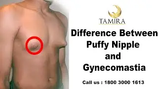 Puffy Nipple vs Gynecomastia l Dr.Jayanthy Ravindran from 