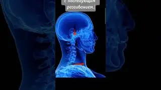 Хлыстовая травма шеи.