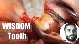Should you extract the upper wisdom tooth after extracting the lower?