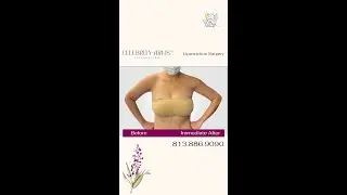 Celebrity Arms™ Liposuction | Immediate Results | Minimal Downtime | Artlipo