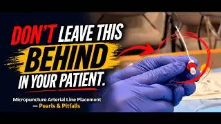 Micropuncture Arterial Line Insertion Tips: Avoid This Dangerous Mistake