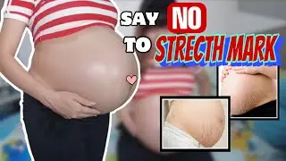 CARA MENGATASI STRETCH MARK PADA MASA KEHAMILAN🤰🏼💕