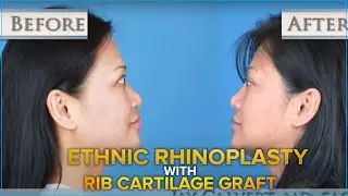 Dr. Jay Calvert - Ethnic Rhinoplasty with Rib Cartilage Graft