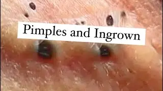 Compilation Pimples and Ingrown