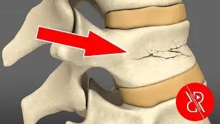 Compression fracture of the spine. How do I live after a spinal injury? Paraplegia and paresis