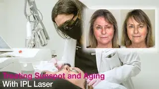 Using Intense Pulse Light to Remove years of Sunspots and Aging | Dr. Ann Mazor Reed | Rendon Center