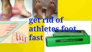 Cure athletes foot fast