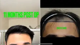 11 MONTHS Update - Motion Hair Clinic, Gangnam