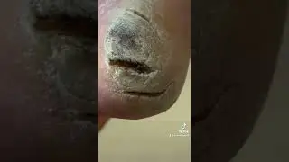 HOW TO TREAT DRY CRACKED HEELS!!😱 