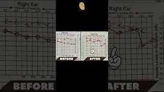 Eardrum before and after surgery I Myringoplasty follow up