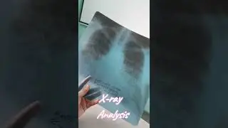 mbbs diaries|| X-ray Analysis||mbbs in Russia||#youtubeshorts #fmge #medicalstudent